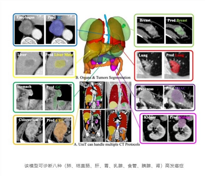 阿里达摩院发布多癌影像分析通用模型